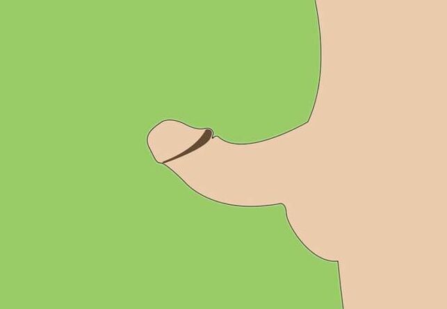 ukrivljenost penisa kot indikacija za kirurško povečanje